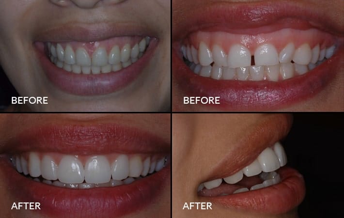 Smile Makeover